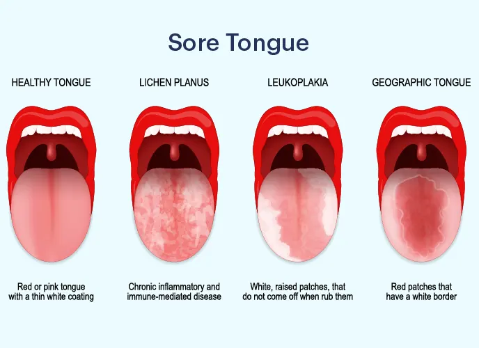 What Causes Thick Yellow Coating on the Tongue - Traditional Chinese ...